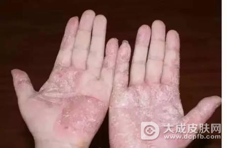 预防手癣 日常做好防范很重要
