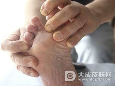 预防手足癣 教你四个秘方