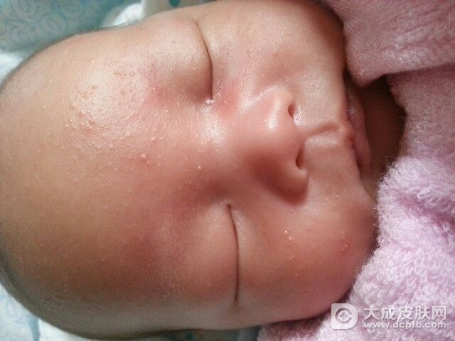 药物易引发湿疹 用药需注意