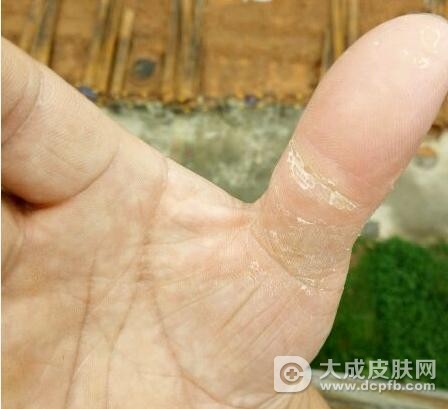 得了手癣该怎么护理