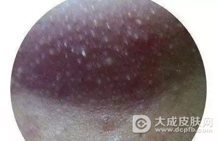 去白头粉刺的小妙招