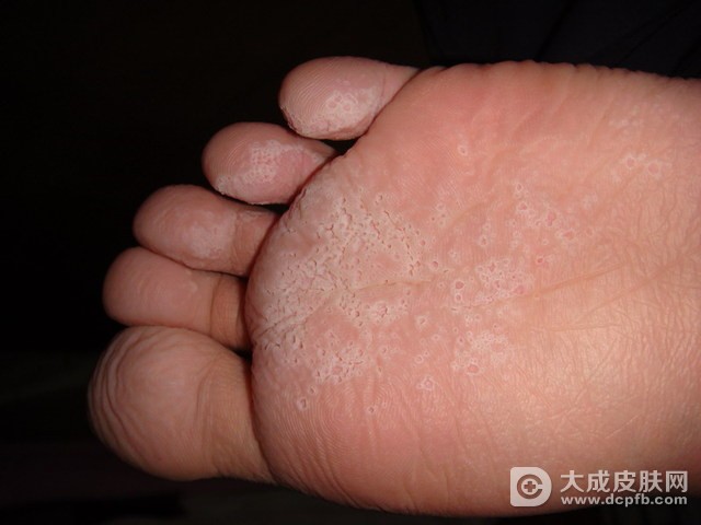 冬季穿皮靴会导致脚气吗