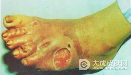 糖尿病足