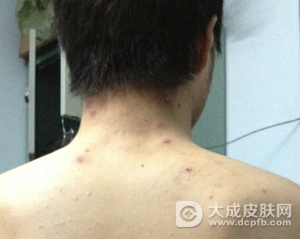 前胸后背爱长痘怎么办