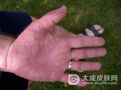 冬季手足皲裂该怎么办