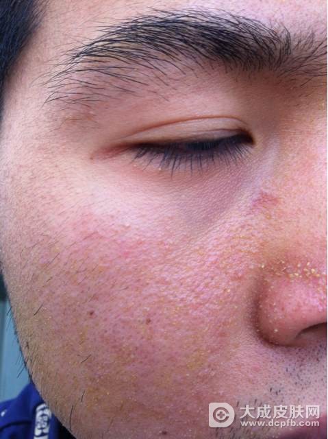 满脸油光爱长痘 可能是脂溢性皮炎