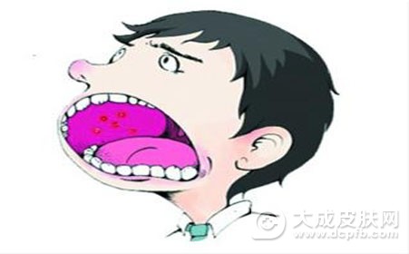 口腔溃疡复发的因素有哪些