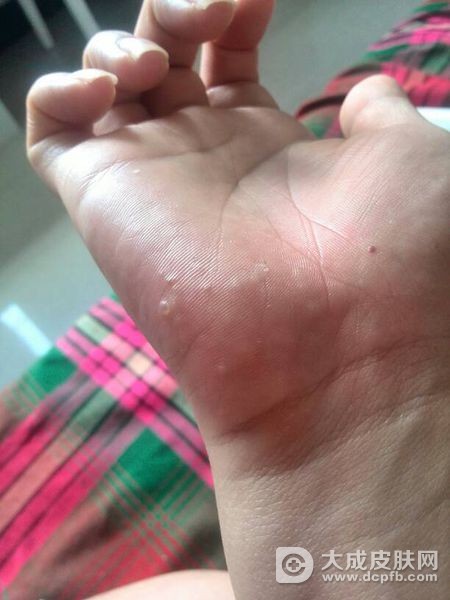 皮肤瘙痒起红点是什么情况