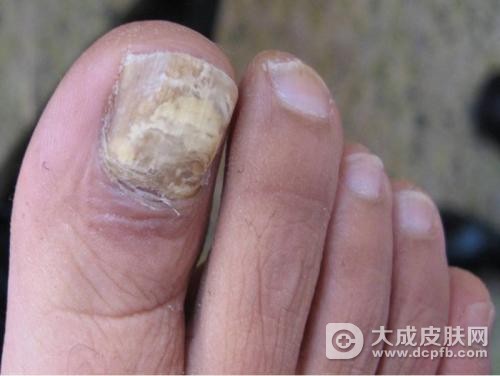 灰指甲在什么情况下易复发
