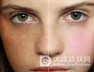 出现黄褐斑的原因有哪些