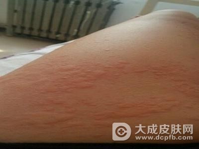 得了荨麻疹会传染吗
