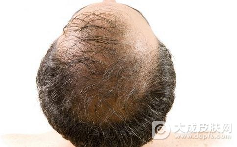 男性易脱发的原因