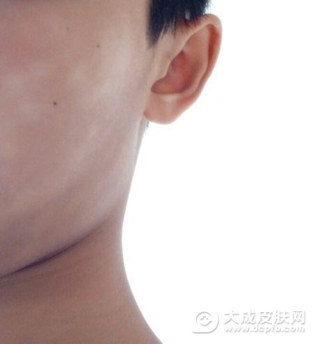 脸上长白斑是白色糠疹吗