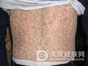 鱼鳞病会有哪些危害
