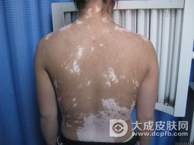 白癜风一直治不好的原因