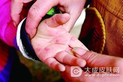 小儿得了手足口病吃什么药