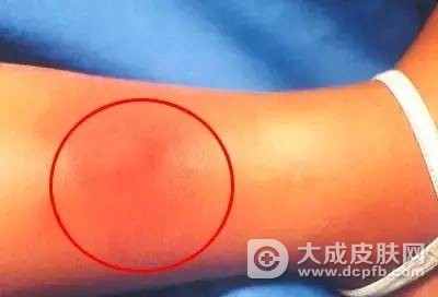 男子被鱼刺伤感染后得丹毒