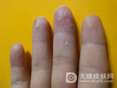 手癣有哪些症状表现
