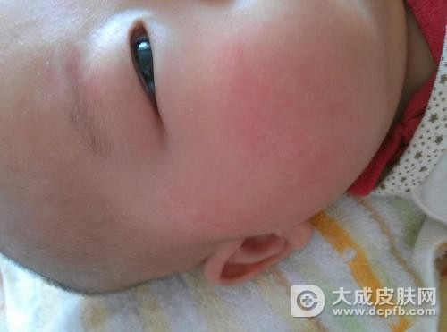 春季家长小心宝宝高发皮肤病