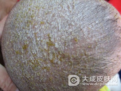 脂溢性皮炎的危害有哪些