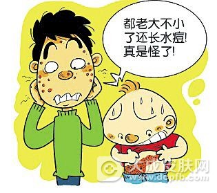 出现水痘切不可随意用激素药膏