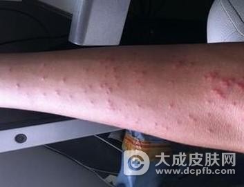 治荨麻疹饮食上注意什么