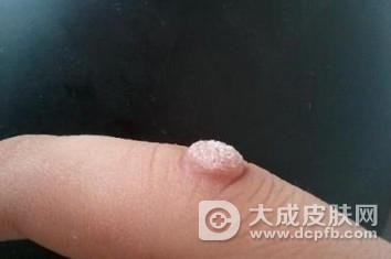 孩子撕倒刺长瘊子怎么办