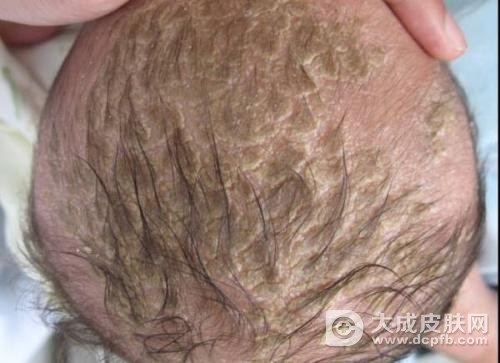 如何防止脂溢性皮炎