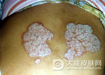 儿童出现银屑病的原因