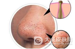 鼻子挤出来条状物是粉刺吗
