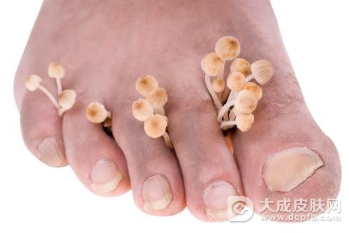 诱发脚气的因素有哪些