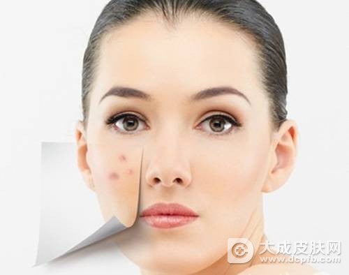 脸上长痘的原因有哪些