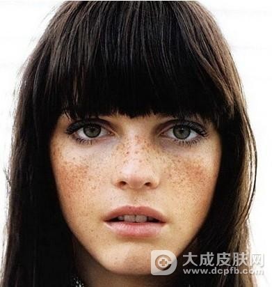 女子脸部斑点发黑 竟因为吃香喝辣