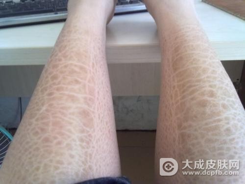 得了鱼鳞病要注意哪些