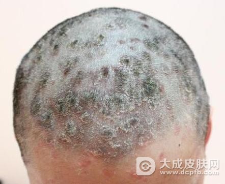 皮肤过敏竟导致出现银屑病