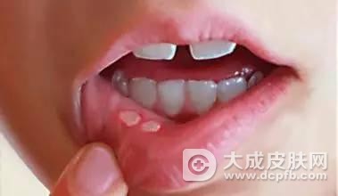 口腔黏膜白斑的症状表现