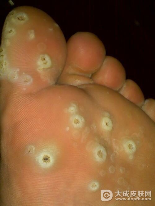 小伙患糖尿病足险些截肢
