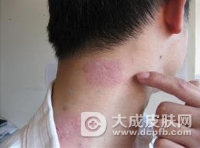 成人脸上长湿疹有哪些原因