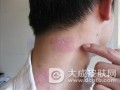 成人脸上长湿疹有哪些原因