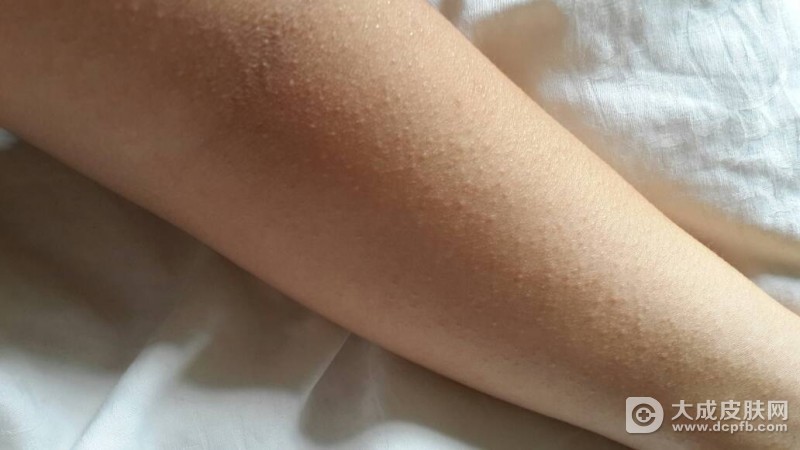 成人湿疹的食疗方法