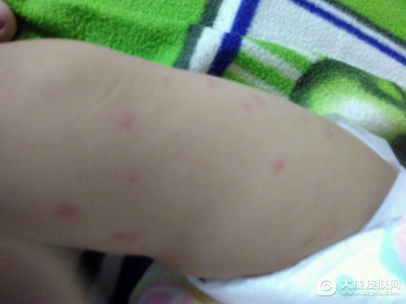小儿荨麻疹有哪些症状