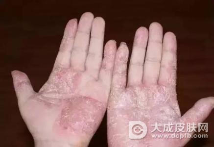 换季手脚爱脱皮怎么办