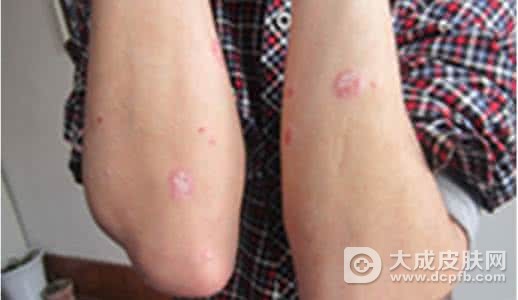 牛皮癣有哪些症状表现
