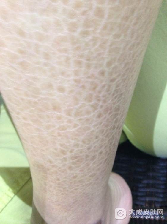 出现蛇皮病的原因有哪些