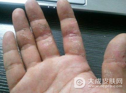 手上出现神经性皮炎怎么护理