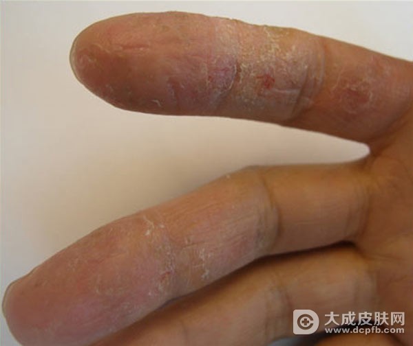 汗疱疹有哪些症状表现