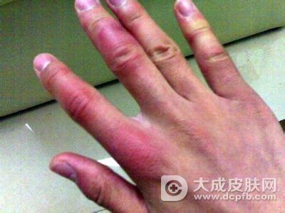 治冻疮的偏方有哪些