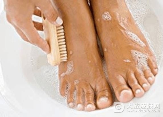 预防脚气的方法有哪些