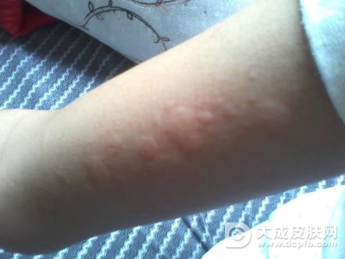 皮肤过敏该如何预防