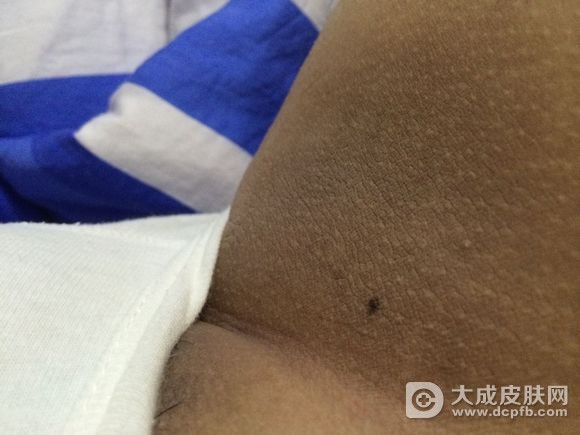 股沟癣该怎么护理